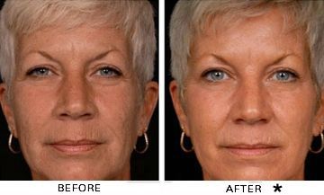 best of Treatments adverse laser effects Facial
