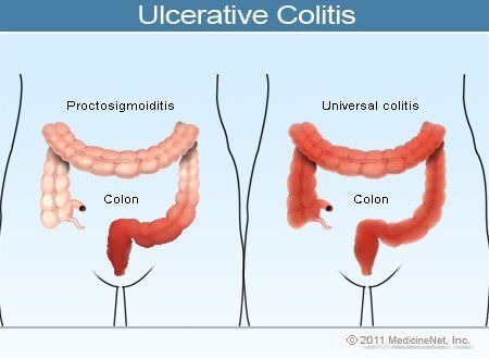 Jelly B. reccomend Sperm ulcerative colitits