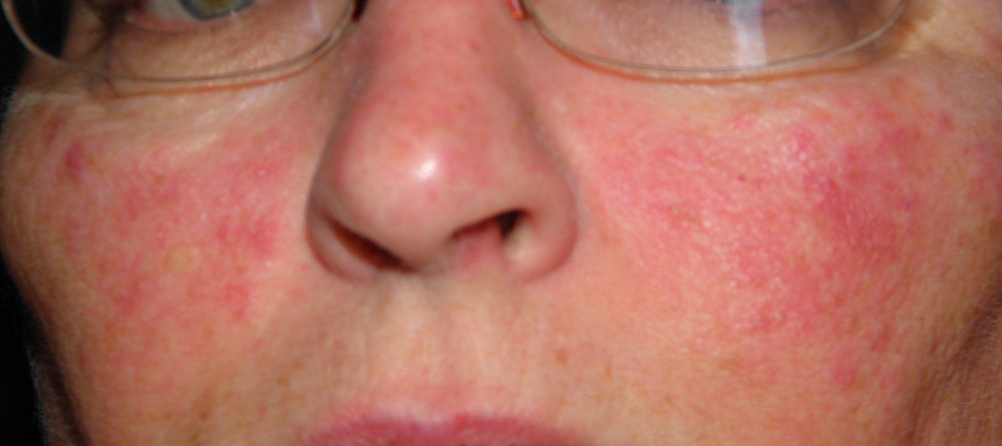 Facial redness but not on cheeks