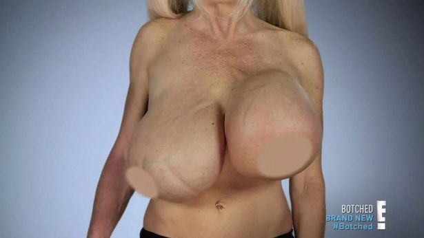 Largest boob implants