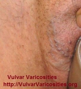best of On Bulging vulva vein
