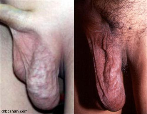 best of Count sperm in Varices scrotum and low